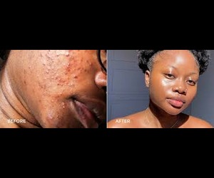 Acne Treatment in Kenya