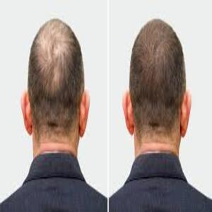 Hair Growth Shampoos for Men