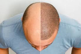 hair growth myths